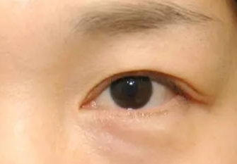 激光去眼袋術(shù)后會(huì)不會(huì)反彈？激光去眼袋術(shù)后注意事項(xiàng)？