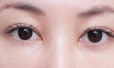 激光去眼袋術(shù)后注意事項(xiàng)有哪些？