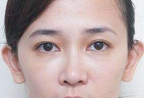 激光去眼袋后要休息多久呢？激光去眼袋會很痛嗎？