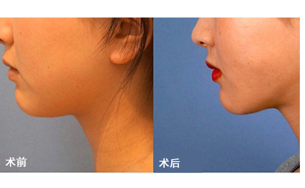 面部吸脂后皮膚會不會松弛？