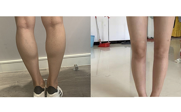 瘦腿針和吸脂哪個(gè)好？