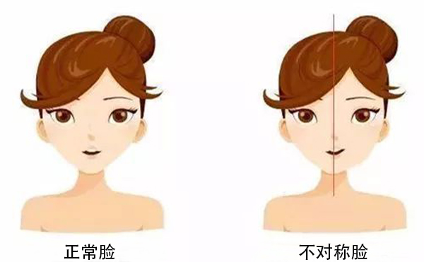 面部不對(duì)稱(chēng)