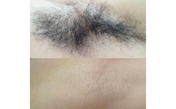 激光脫腋毛疼嗎？
