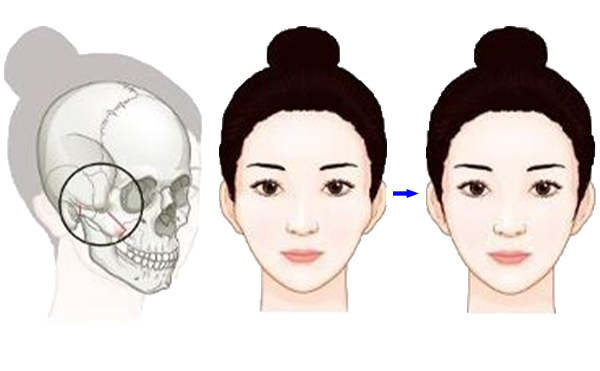 顴骨降低整形手術(shù)是怎么操作的？有什么特點(diǎn)？