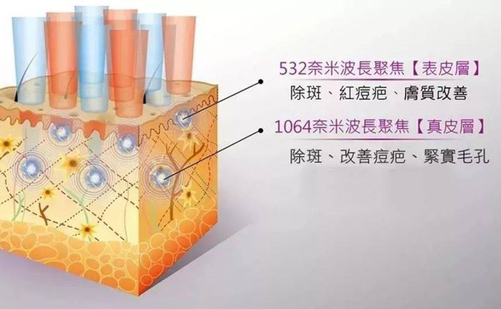 皮秒祛斑恢復(fù)期多久？