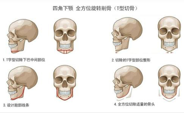 太原麗都整形專家：切下頜角手術(shù)風(fēng)險(xiǎn)主要是這六點(diǎn)