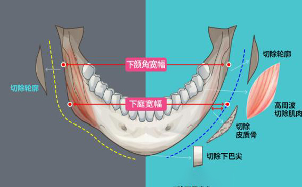 哪些因素會影響到下頜角手術(shù)的安全?