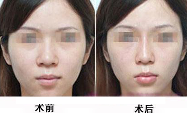 鼻頭縮小手術是怎么做的？術后應該怎么護理