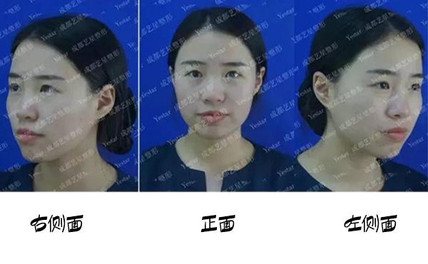 福州名韓整形改善蒜頭鼻大概要花多少錢？