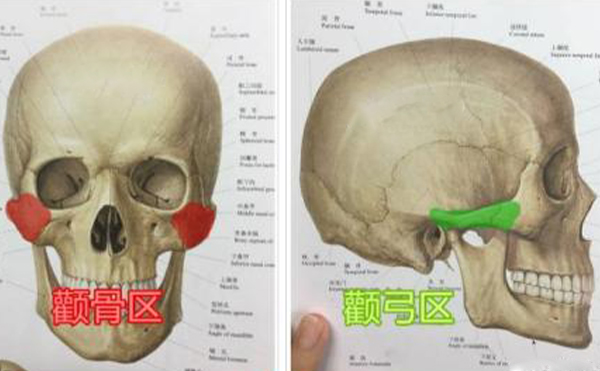顴骨整形手術(shù)多久能消腫？