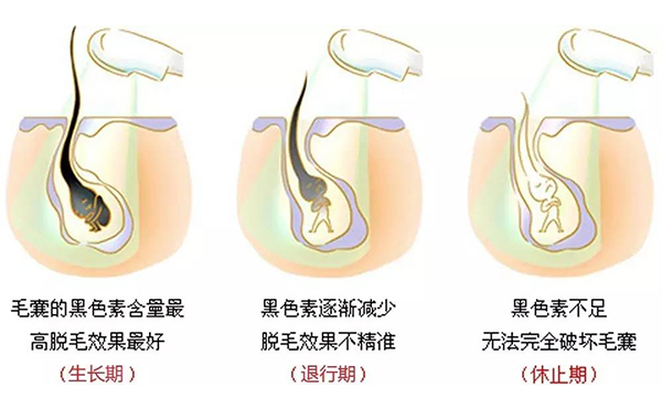 冰點(diǎn)脫毛