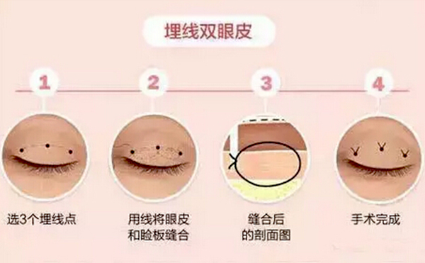 全切雙眼皮跟埋線的區(qū)別是什么？哪個(gè)好？