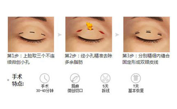 韓式三點雙眼皮的手術(shù)過程是什么?術(shù)后怎么避免疤痕增生?