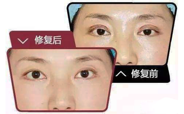哪些情況需做雙眼皮修復(fù)？修復(fù)難度大不大?