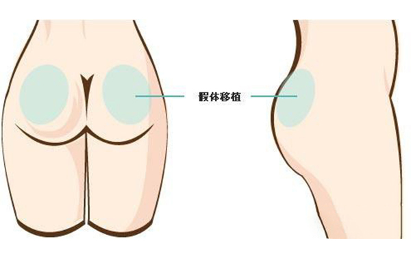 假體豐臀有副作用嗎?術后會不會留疤?