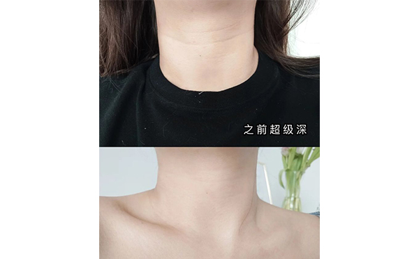 激光去頸紋適合哪些人？