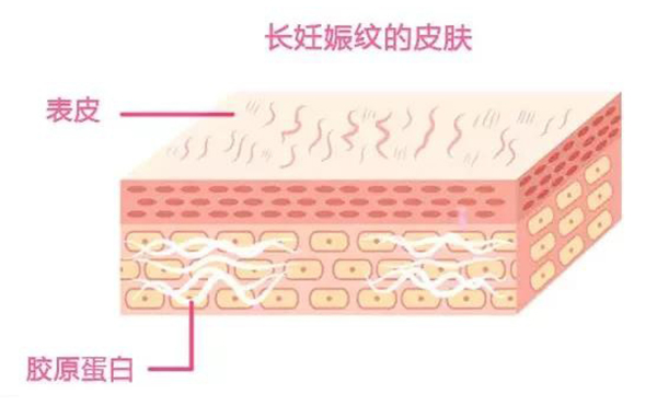妊娠紋是怎么形成的？