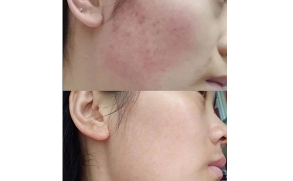 彩光嫩膚會讓皮膚變薄嗎？