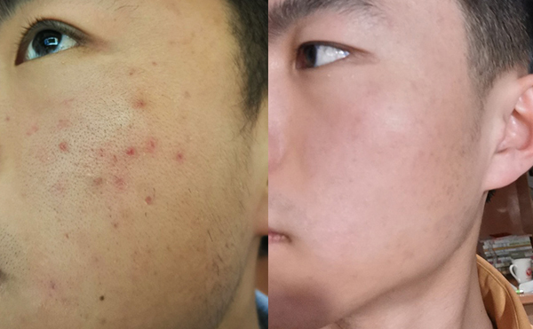 白瓷娃娃每次治療間隔多久？
