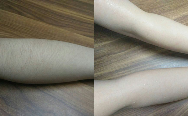 冰點(diǎn)手臂脫毛會(huì)傷害皮膚嗎？