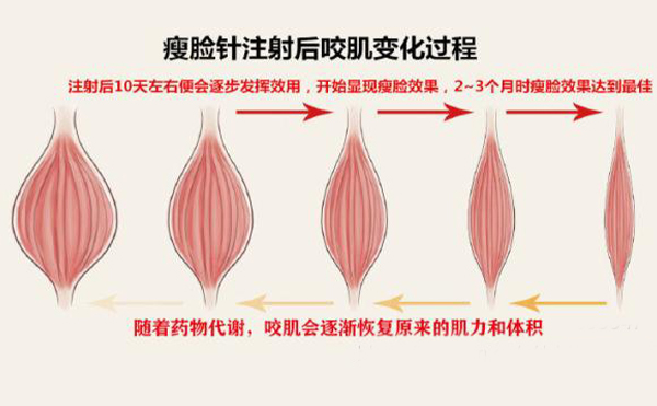 打瘦臉針打多少單位？