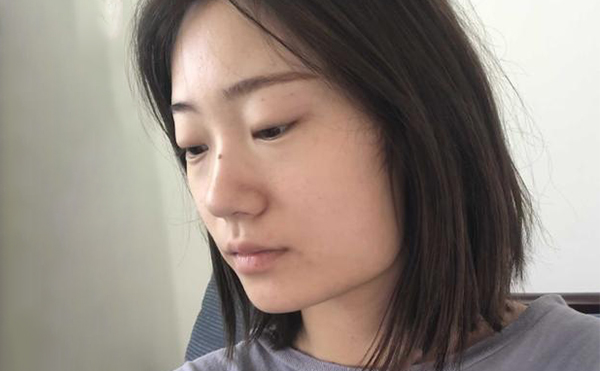 下頜角整形適宜人群有哪些？
