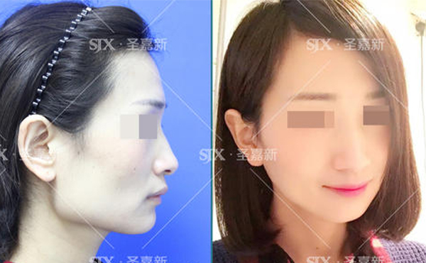 下頜角整形后皮膚是否會松弛？