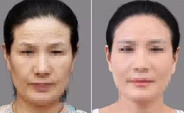 激光除皺有什么優(yōu)勢(shì)？