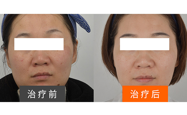 彩光嫩膚安全不安全？
