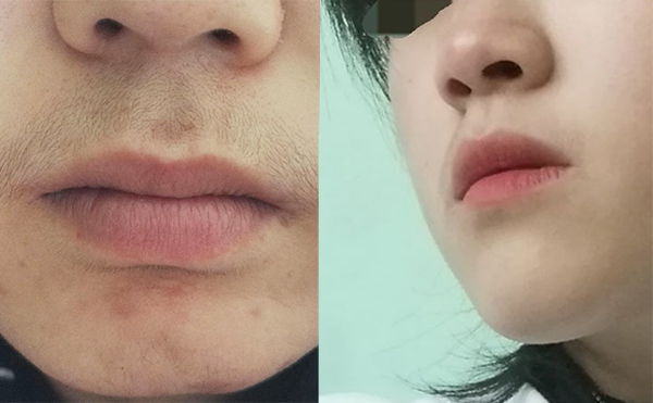 激光脫毛的效果怎么樣？