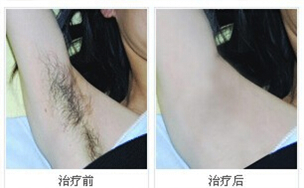 冰點(diǎn)脫腋毛安全嗎？