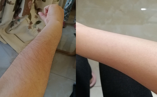 光子手臂脫毛幾次能脫完？