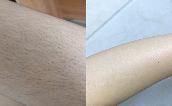 激光手臂脫毛安全嗎？