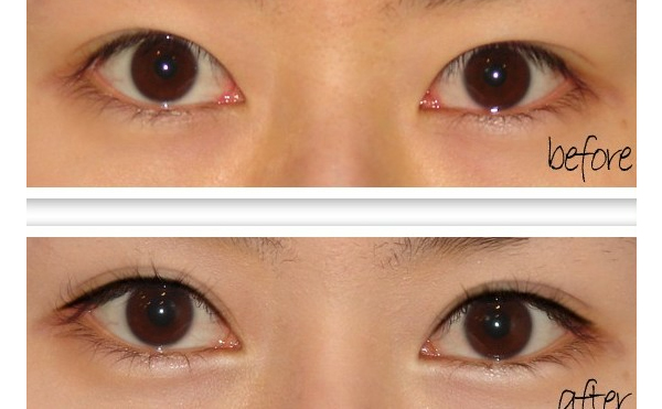 開(kāi)眼角手術(shù)有什么原則？