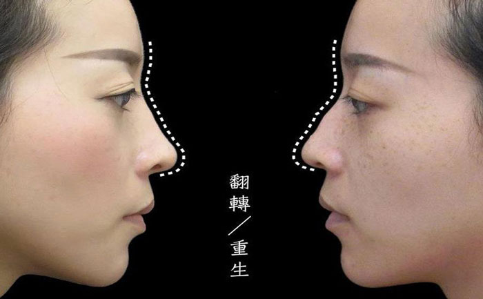 駝峰鼻矯正多少錢？駝峰鼻矯正有危險嗎？