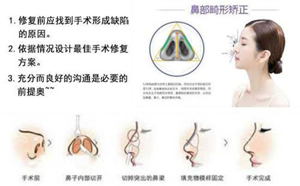 隆鼻修復(fù)效果怎么樣？
