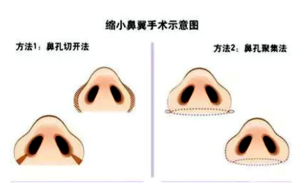  鼻翼縮小有后遺癥嗎？會不會反彈