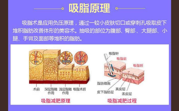 水動力吸脂效果好嗎？