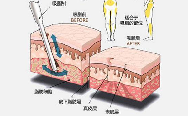 大腿吸脂有什么優(yōu)點(diǎn)？