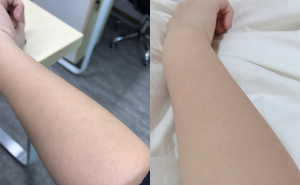 冰點脫毛有什么優(yōu)勢？