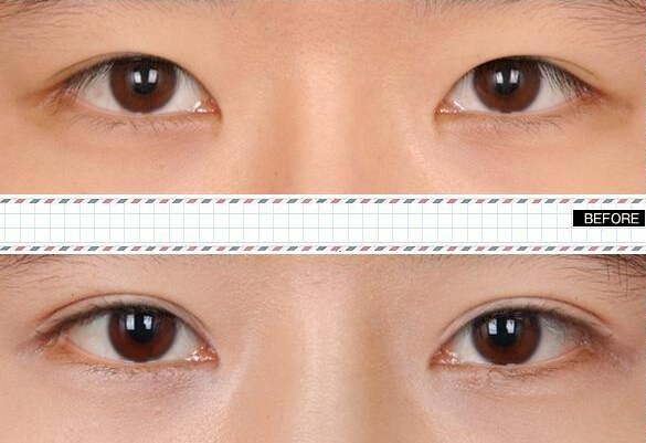 做雙眼皮價格是多少？哪種眼睛適合做雙眼皮呢?