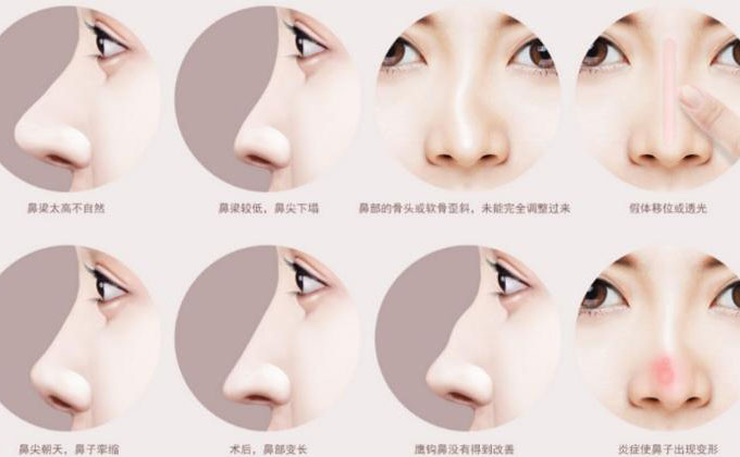 鼻尖整形大概多少錢？