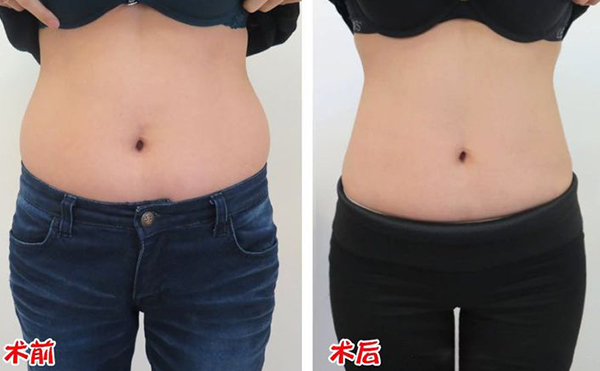 腹部吸脂效果如何？