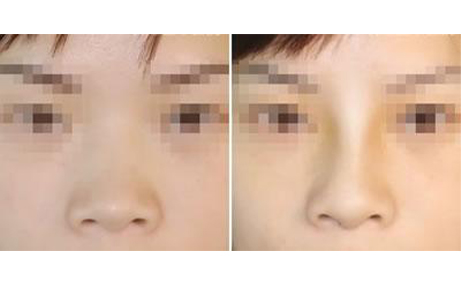 做隆鼻手術會留疤嗎？