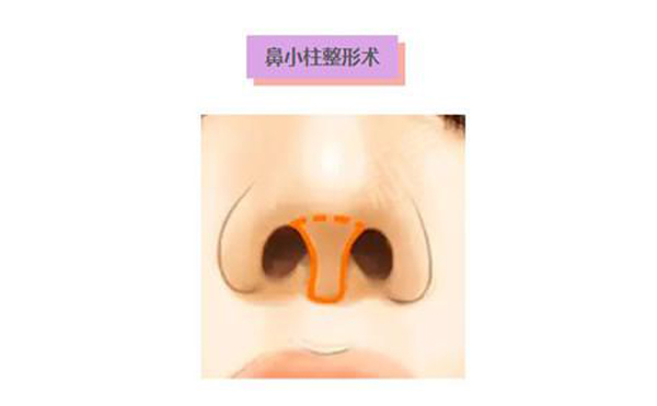 鼻小柱延長術(shù)是什么？鼻小柱延長手術(shù)有什么優(yōu)點