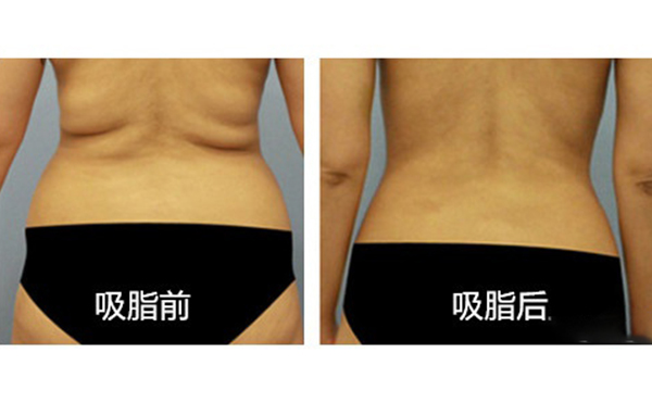 腹部吸脂需要多久恢復(fù)？