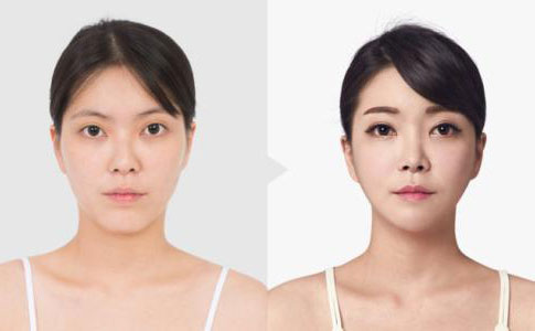 韓式埋線雙眼皮多久恢復自然？