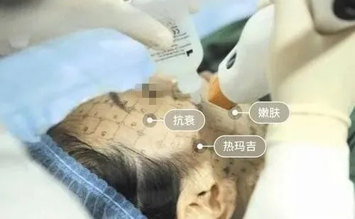 牙齒矯正期間是不能做熱瑪吉嗎？