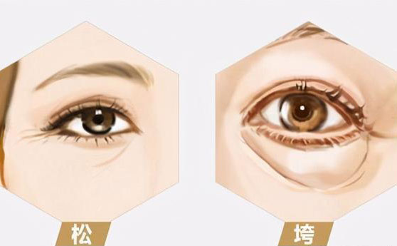 無痛去眼袋價格多少錢？