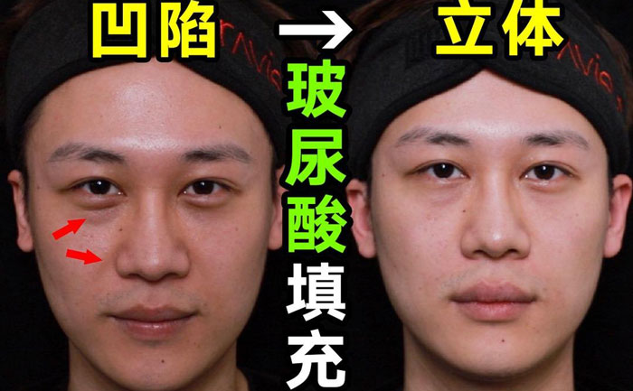 淚溝填充用什么方法最好？淚溝填充手術(shù)大約多少錢？
